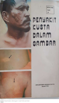 Image of Penyakit Kusta dalam Gambar