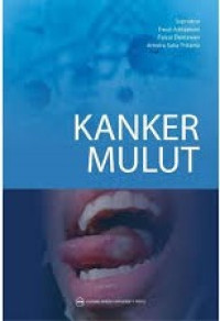 Image of Kanker Mulut