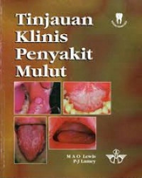 Image of Tinjauan Klinis Penyakit Mulut